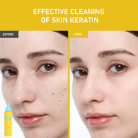 PHOFAY GENTLE PEELING SOLUTION PAPAYA ENZYME AHA BHA - image 4